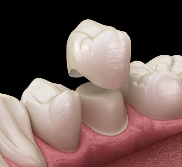 guide-to-dental-crowns